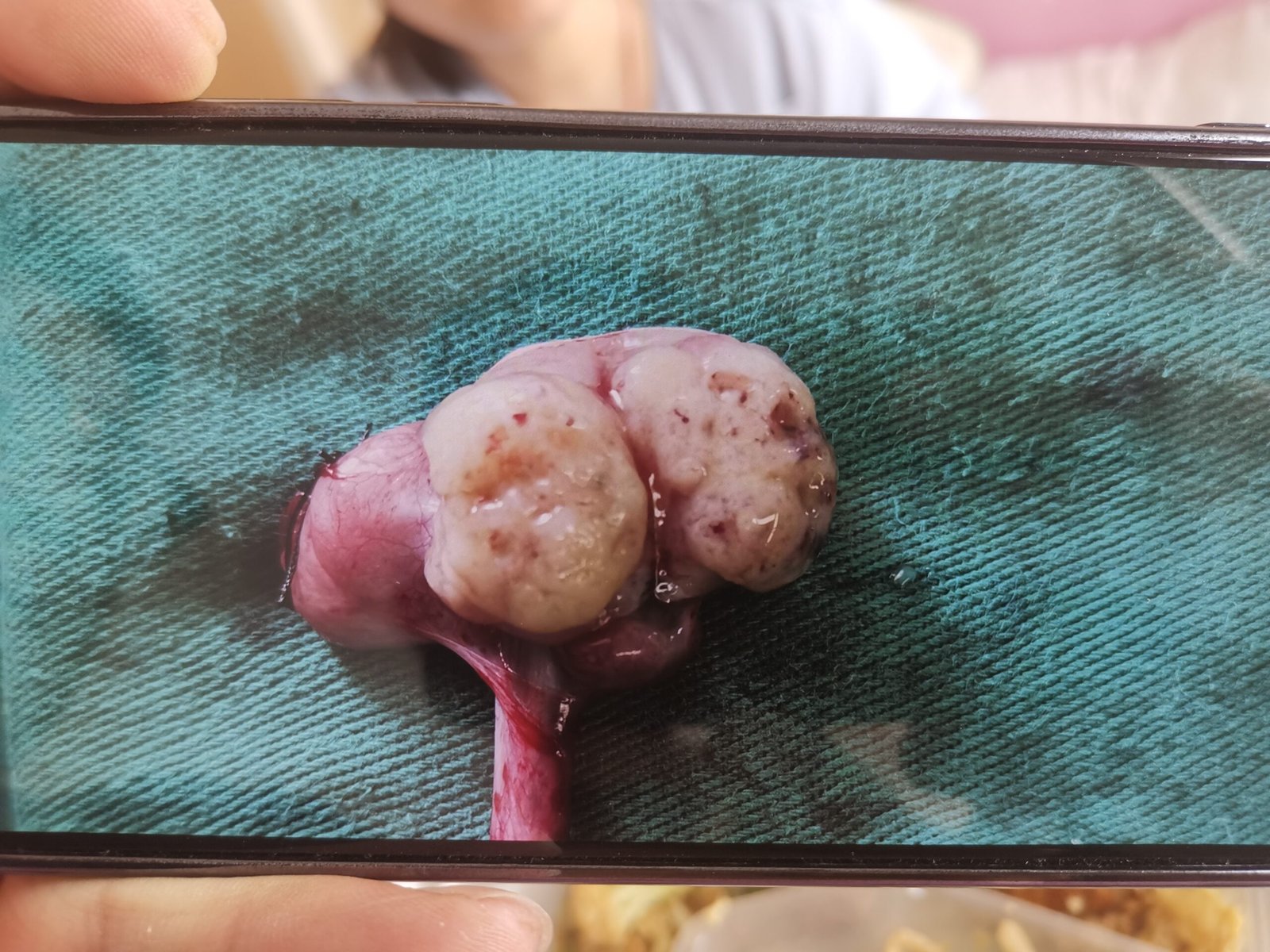 The surgical resection site of yolk sac tumor in Tubao