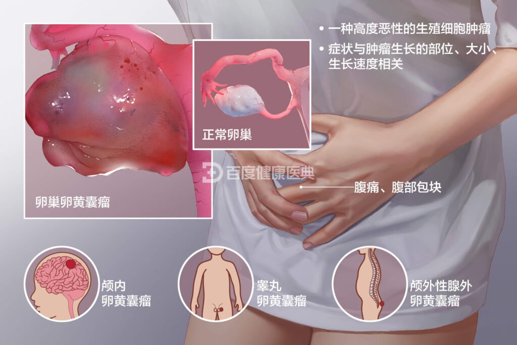 types of yolk sac tumor